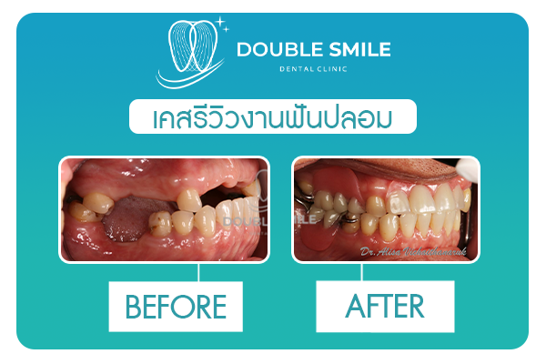 เคสรีวิวฟันปลอม