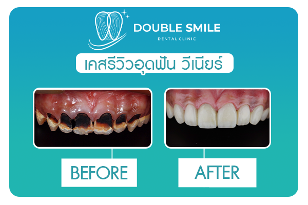 เคสรีวิวอุดฟัน-วีเนียร์