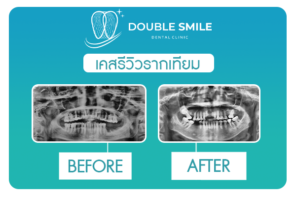 รากเทียม